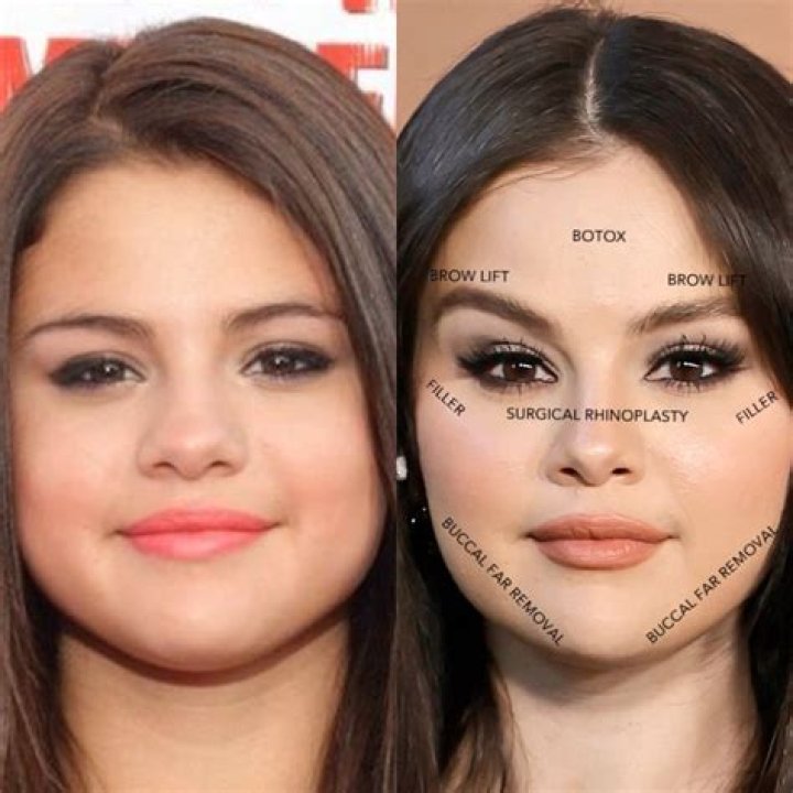 Has Selena Gomez Had Plastic Surgery? Thought to Have Breast Augmentation